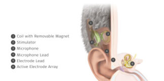 MED-EL Launches World’s First Commercially Available Totally Invisible Cochlear Implant